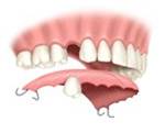 Perfect Smile  acrilic partial-denture